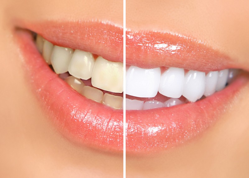 teeth whitening services in Milford, MA