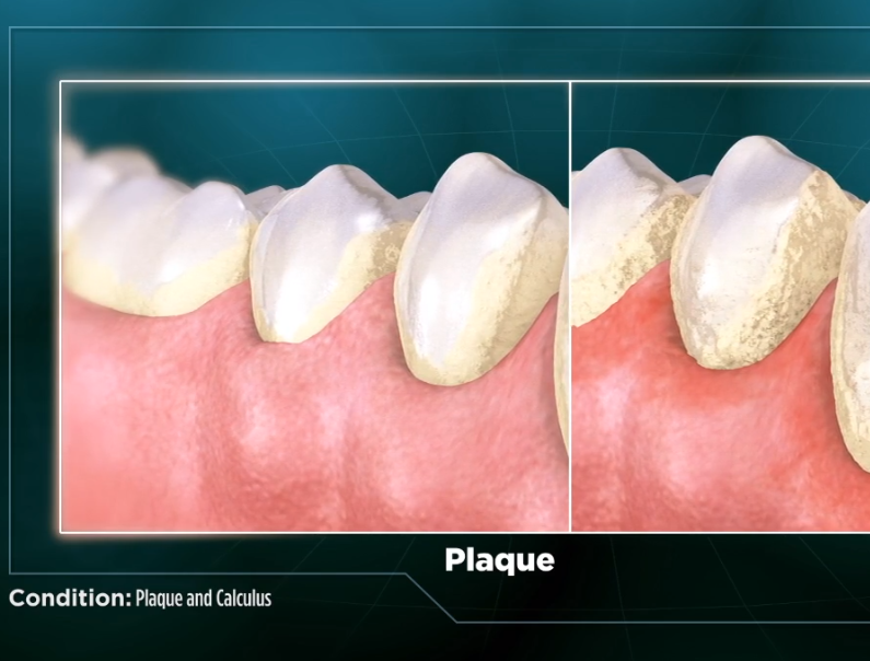 Plaque and Calculus | New Horizons Family Dental